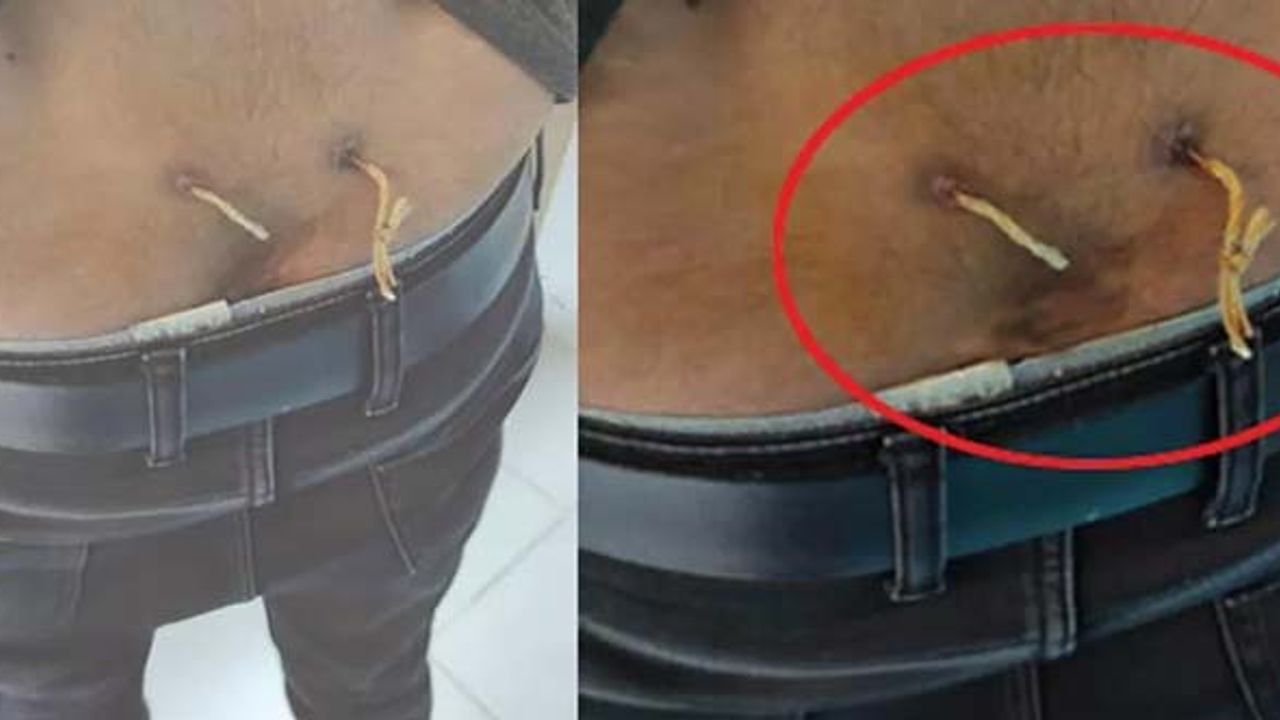 Deri altından çamaşır ipi geçirdiler! Doktor şok oldu...