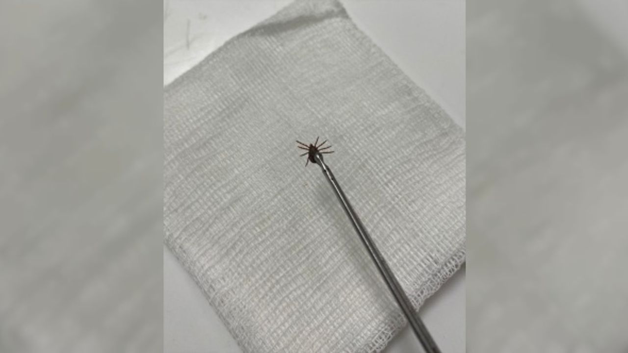 Ağrı şikayetiyle hastaneye başvuran kadının kulak zarından kene çıktı