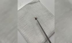 Ağrı şikayetiyle hastaneye başvuran kadının kulak zarından kene çıktı